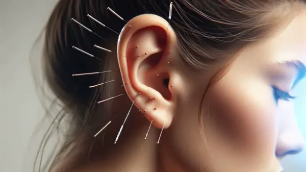 una ragazza di profilo con applicati gli aghi per l'agopuntura sull'orecchio, l'immagine rappresenta il corso di cromoterapia e auricoloterapia